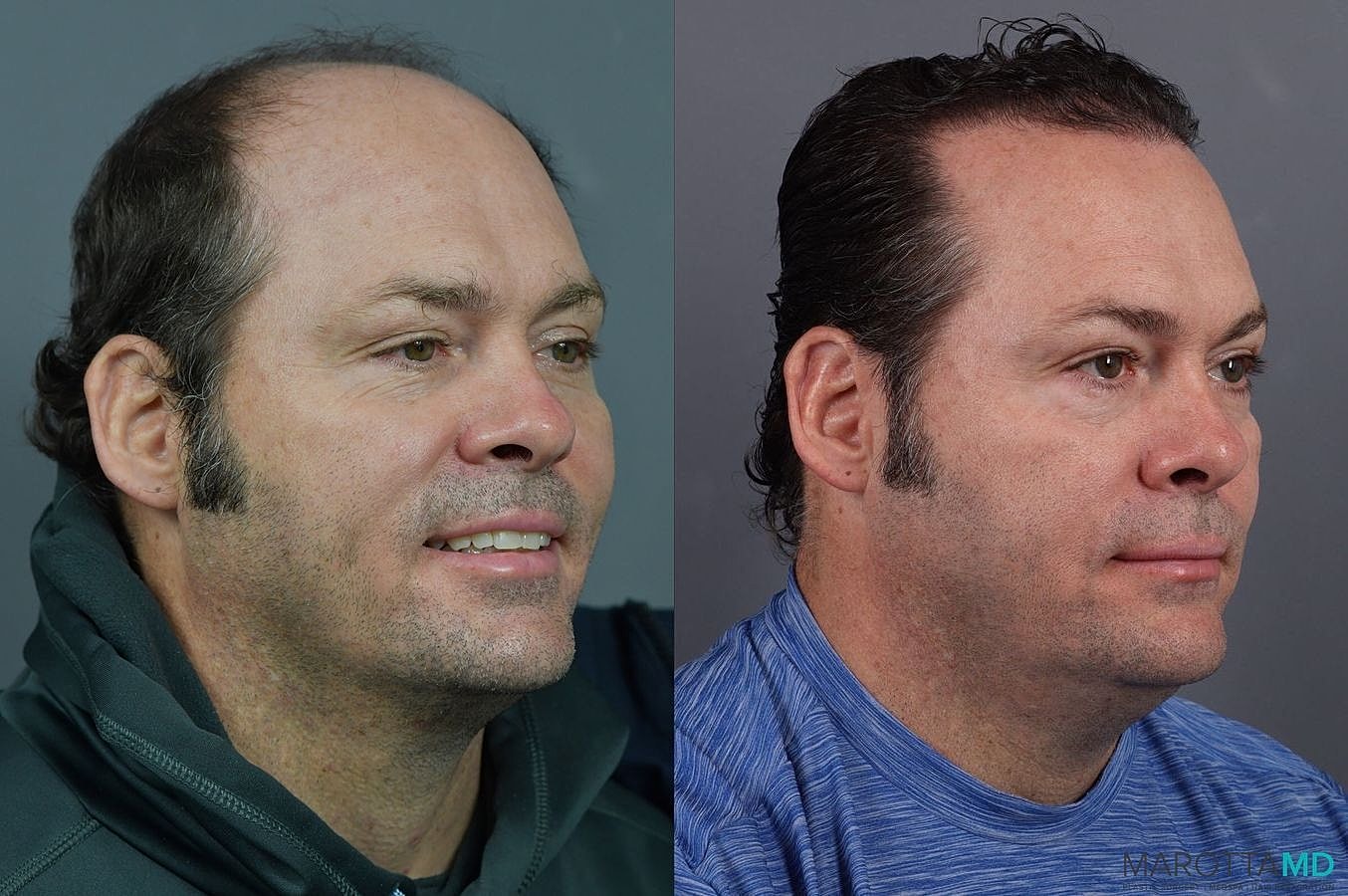 Hair Transplants Before & After