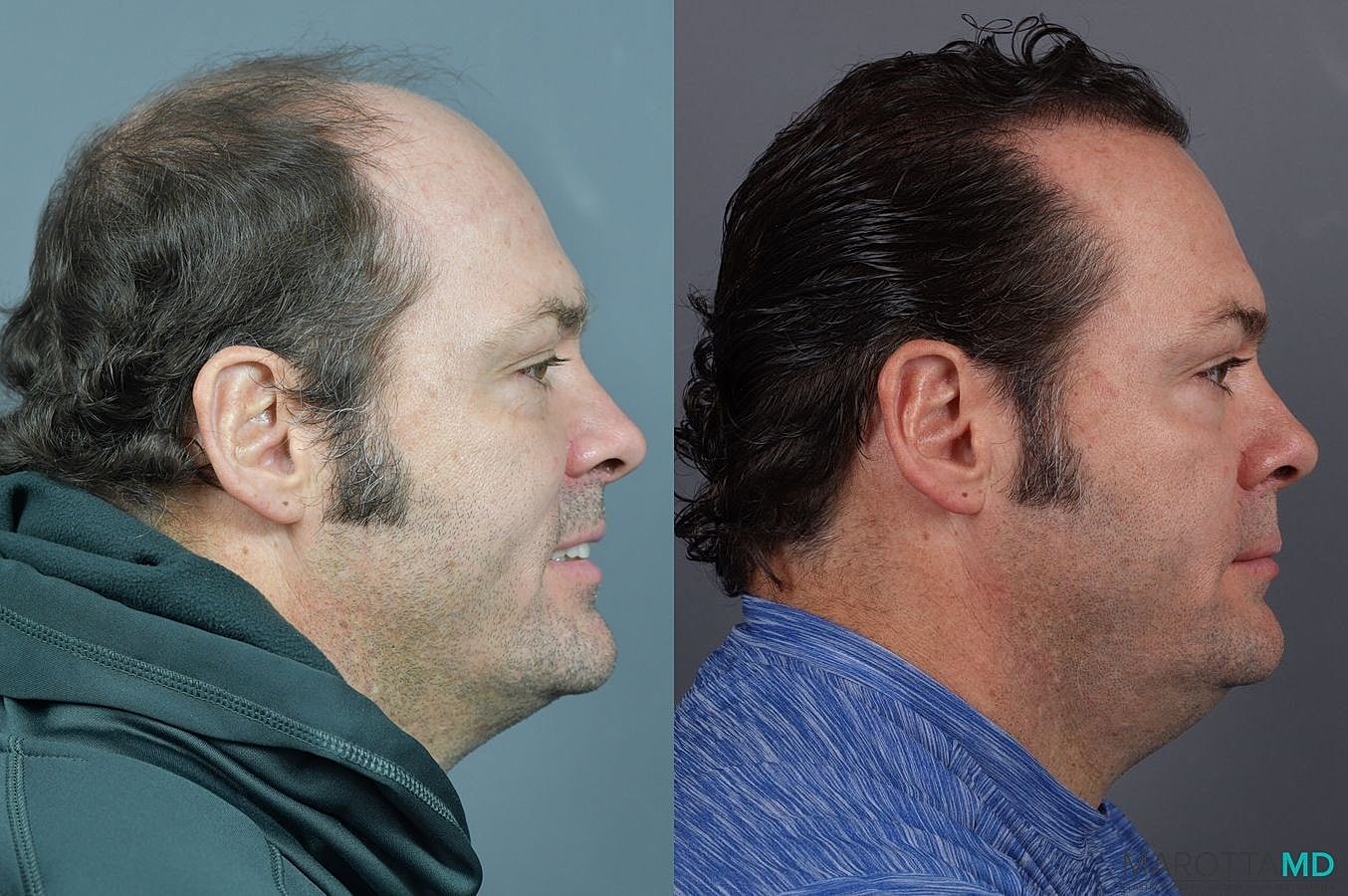 Hair Transplants Before & After