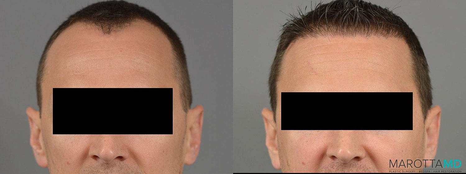 Hair Transplants Before & After
