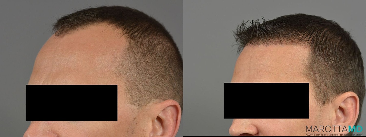 Hair Transplants Before & After