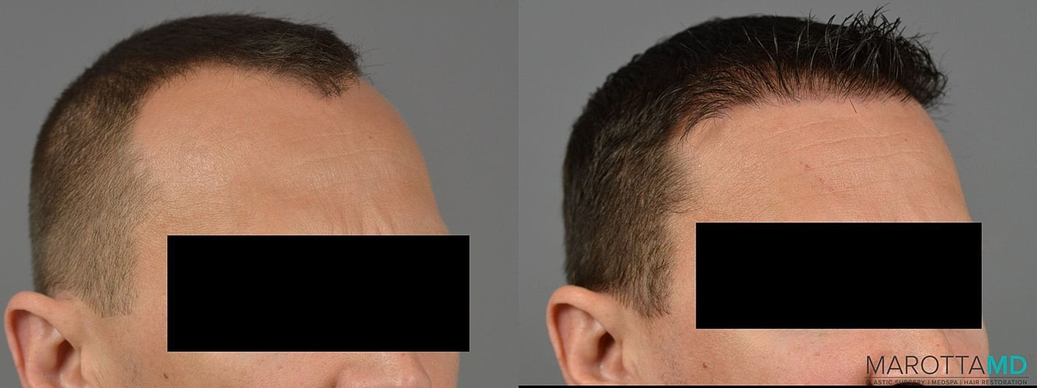 Hair Transplants Before & After