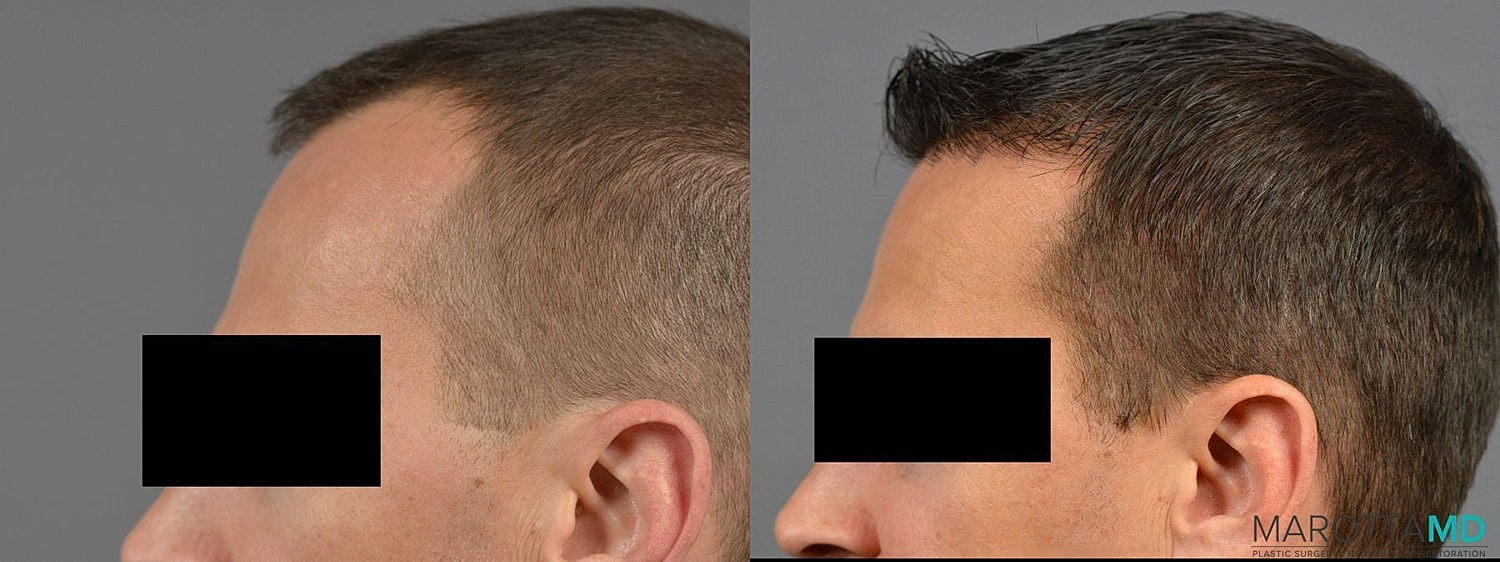 Hair Transplants Before & After