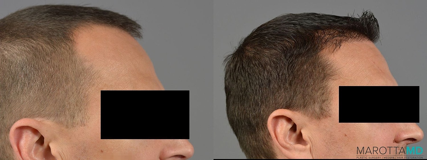 Hair Transplants Before & After
