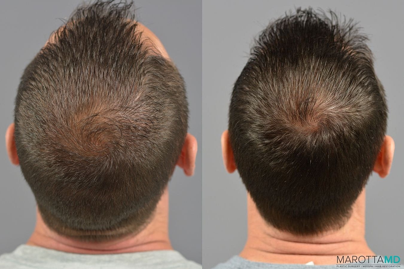 Hair Transplants Before & After