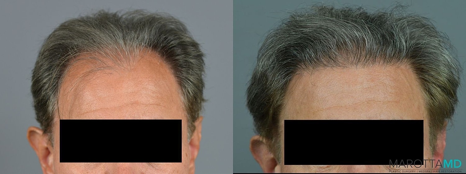 Hair Transplants Before & After