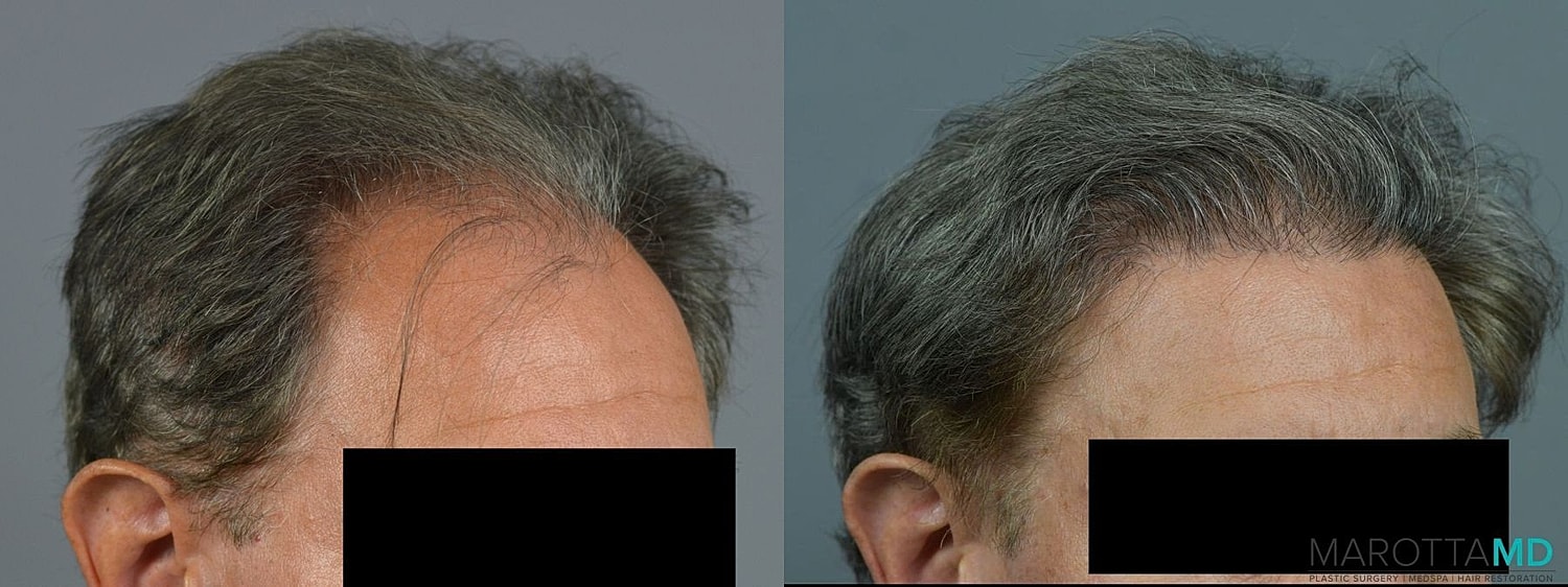 Hair Transplants Before & After
