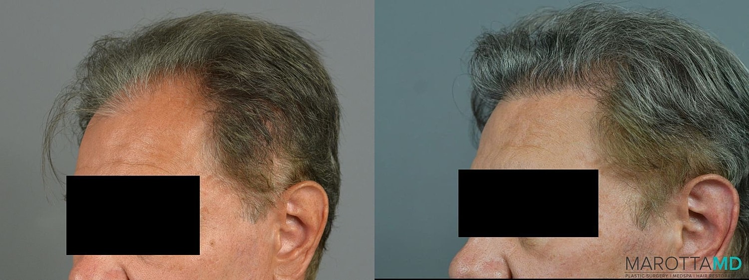 Hair Transplants Before & After