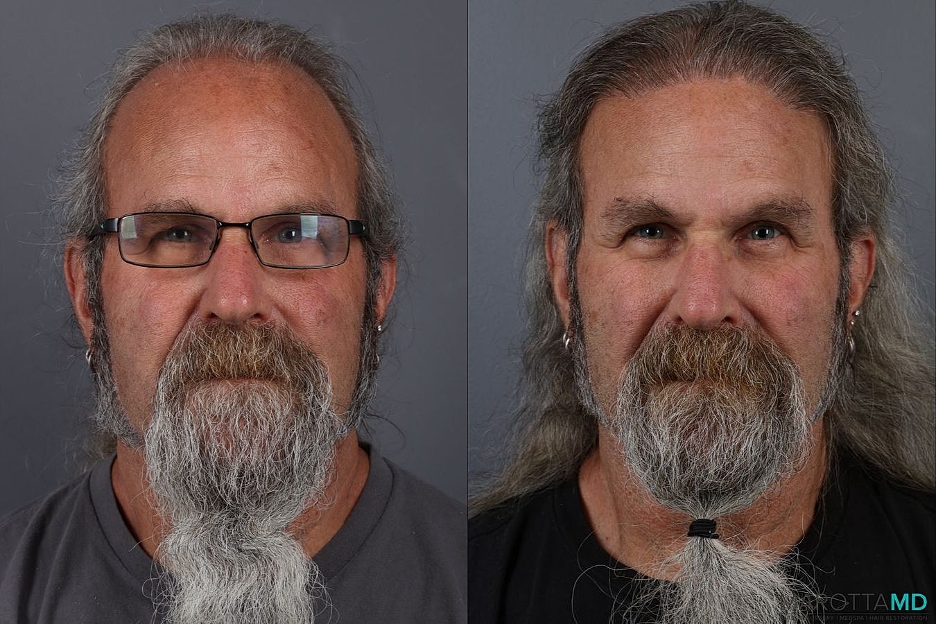 Hair Transplants Before & After