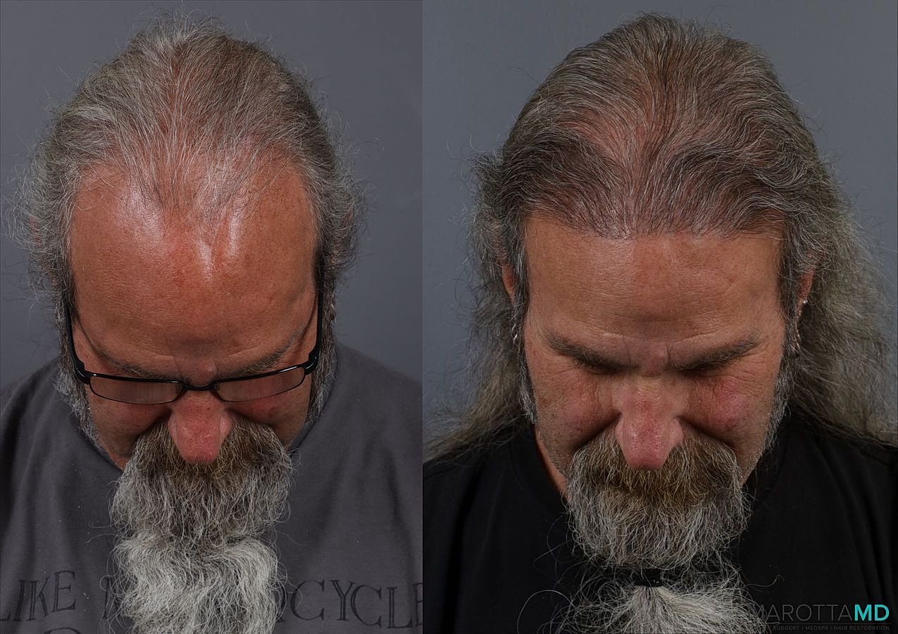 Hair Transplants Before & After