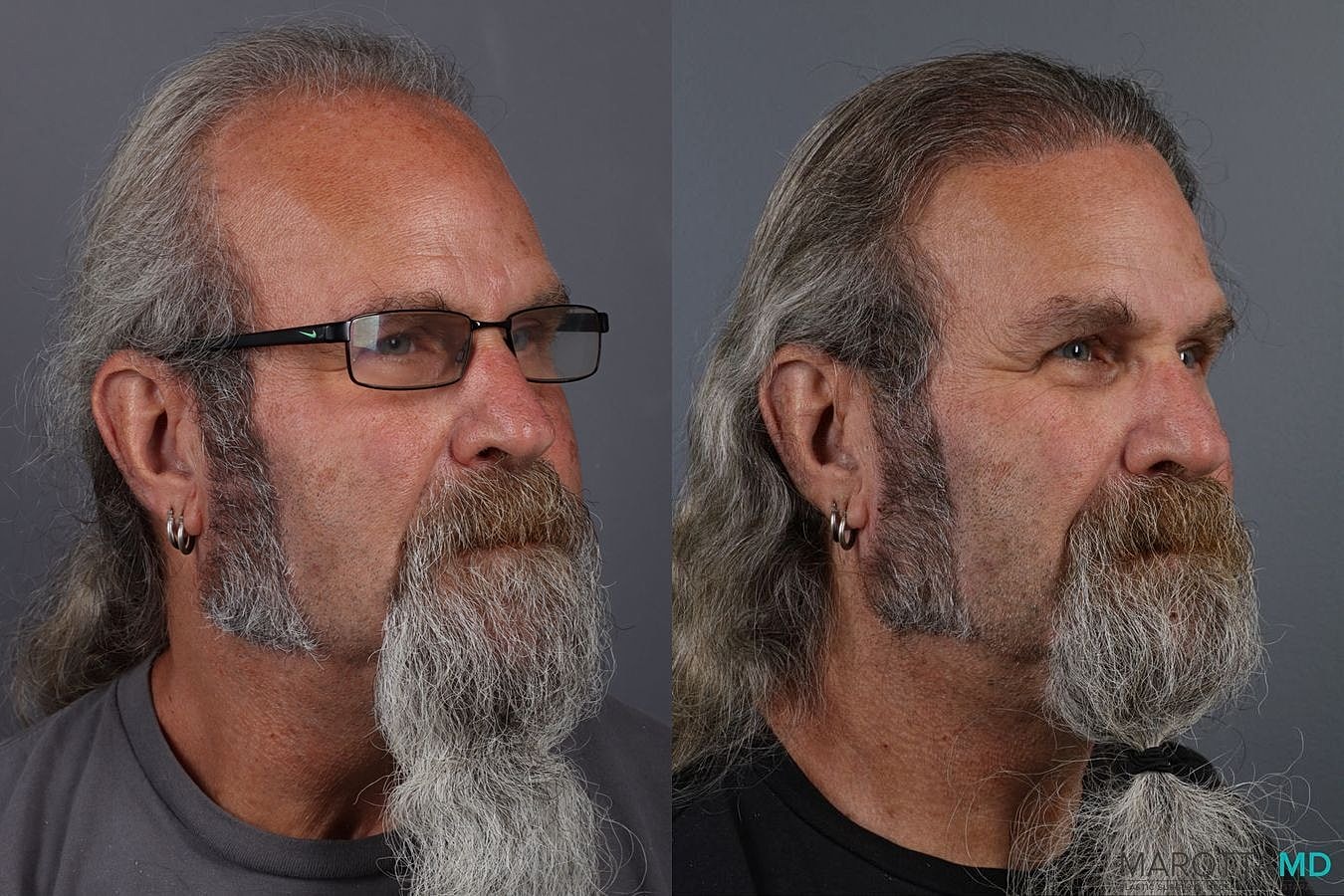 Hair Transplants Before & After