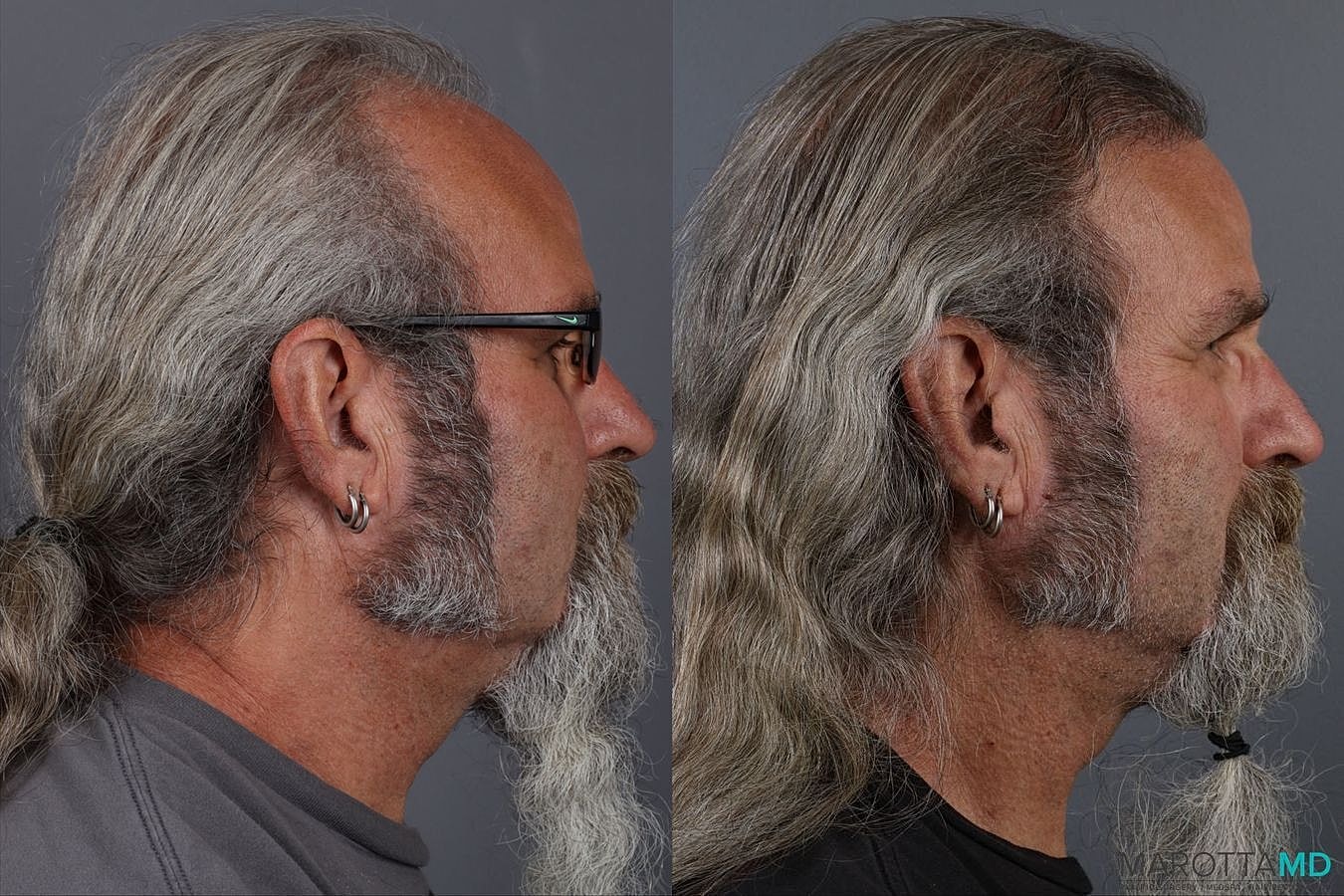 Hair Transplants Before & After