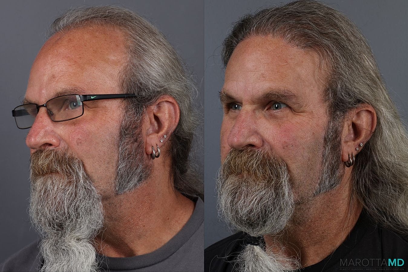 Hair Transplants Before & After