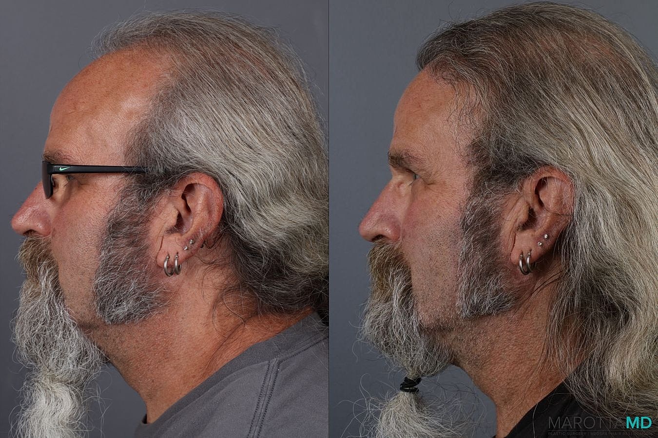 Hair Transplants Before & After