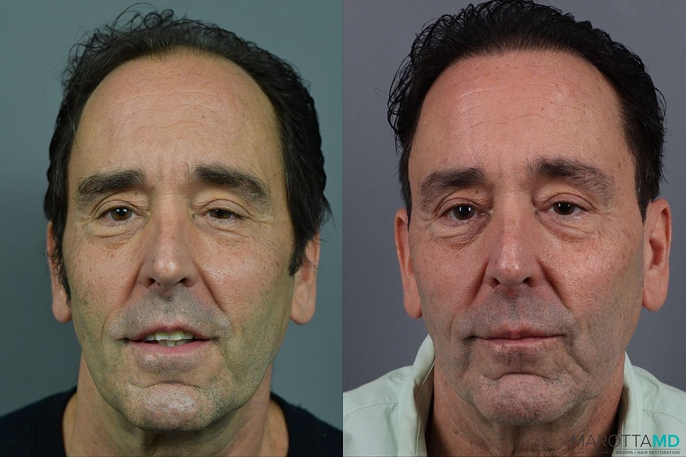 Hair Transplants Before & After