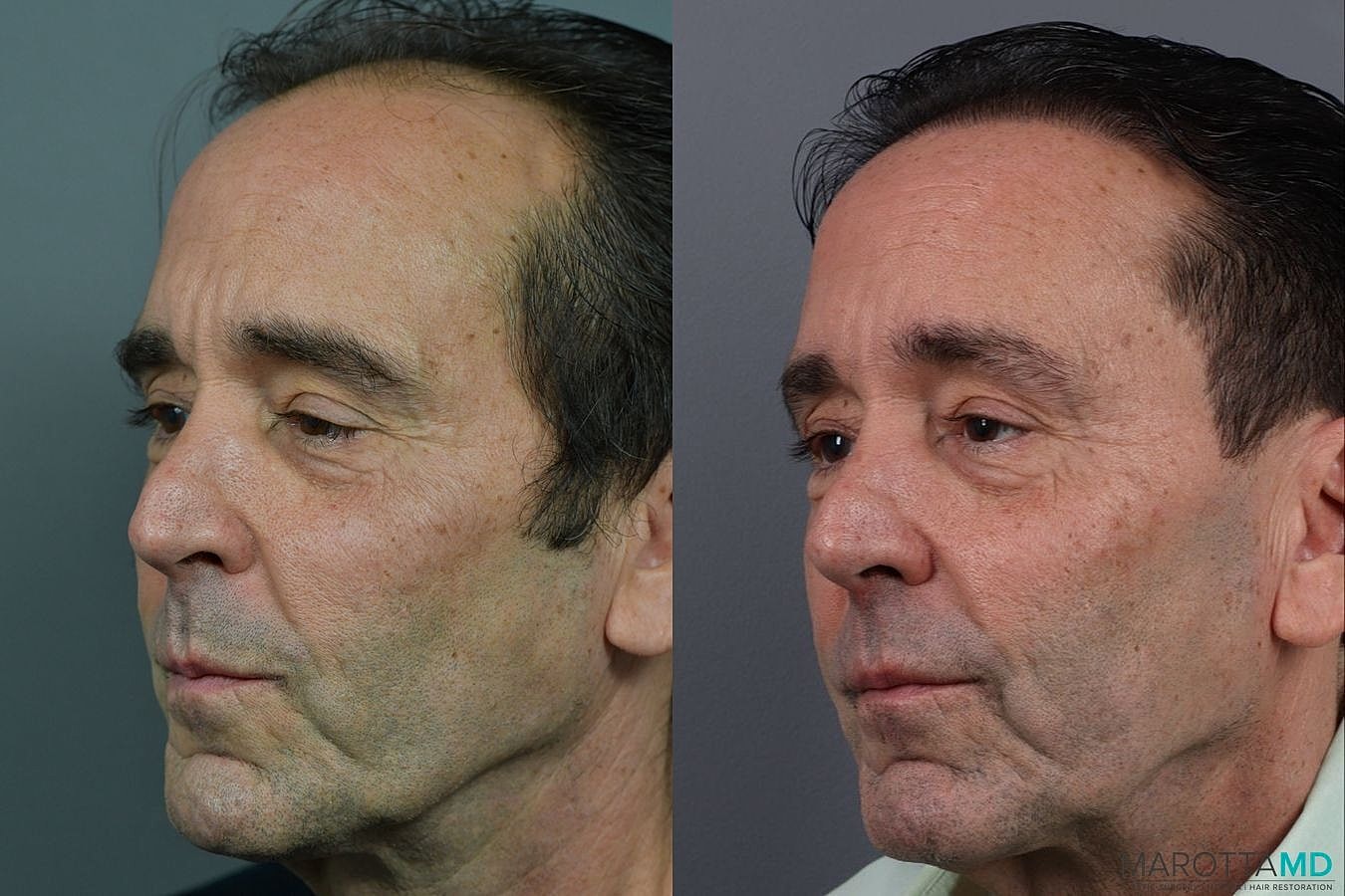 Hair Transplants Before & After