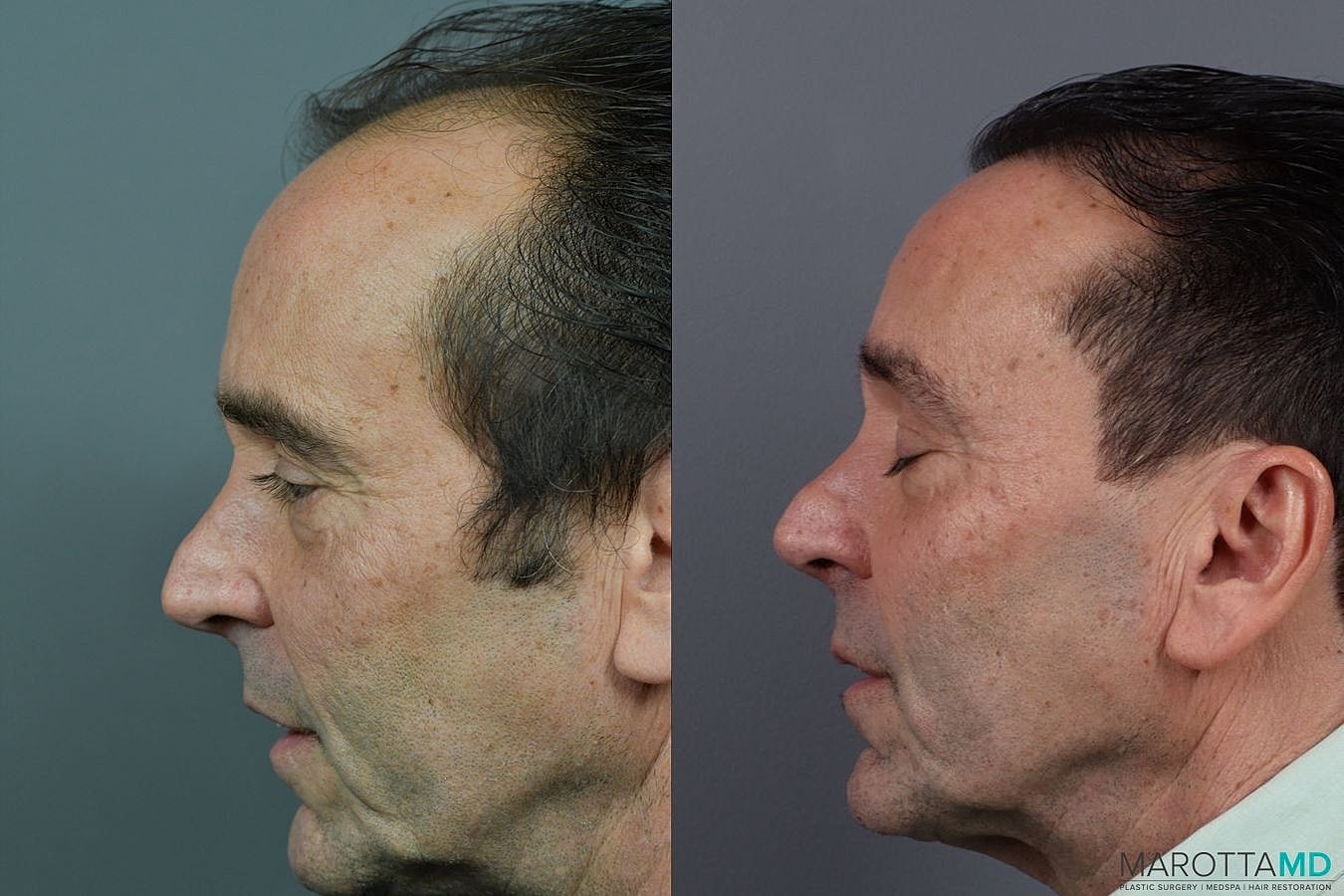 Hair Transplants Before & After