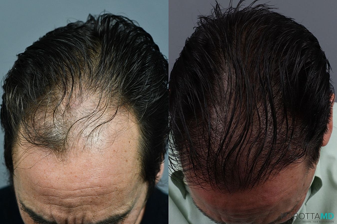 Hair Transplants Before & After