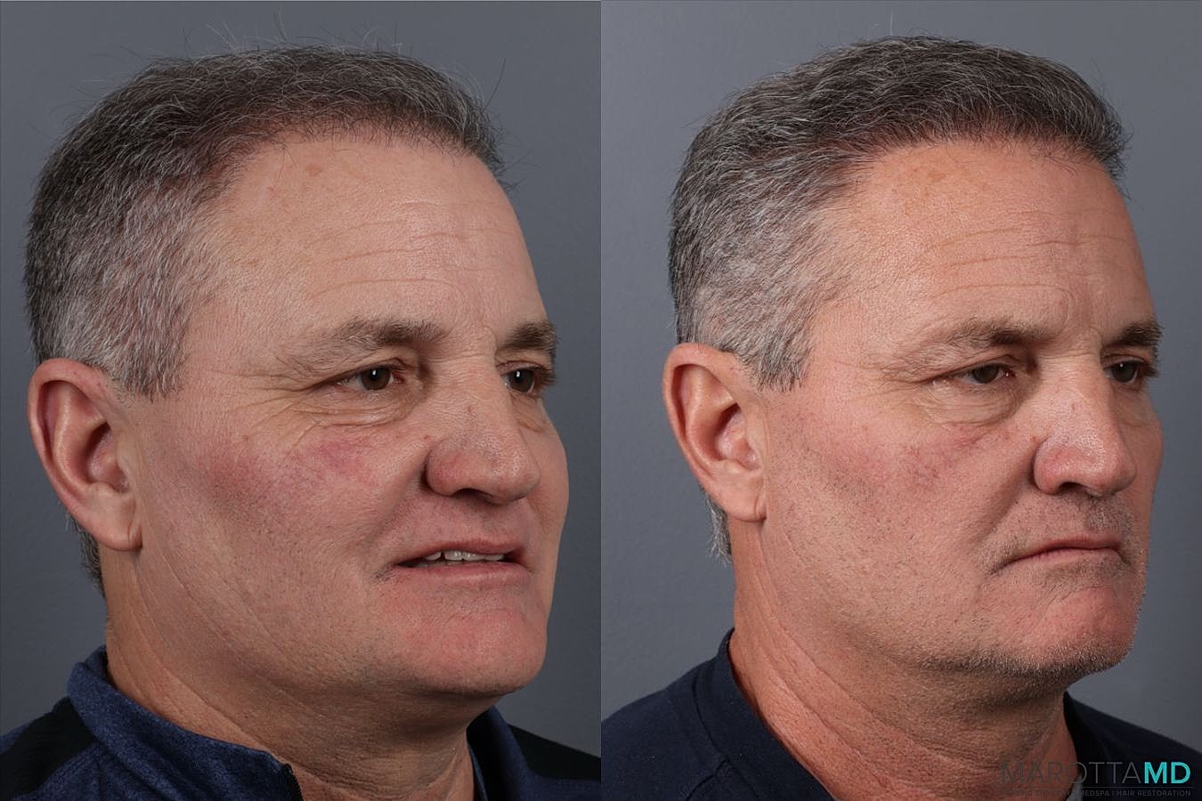Hair Transplants Before & After