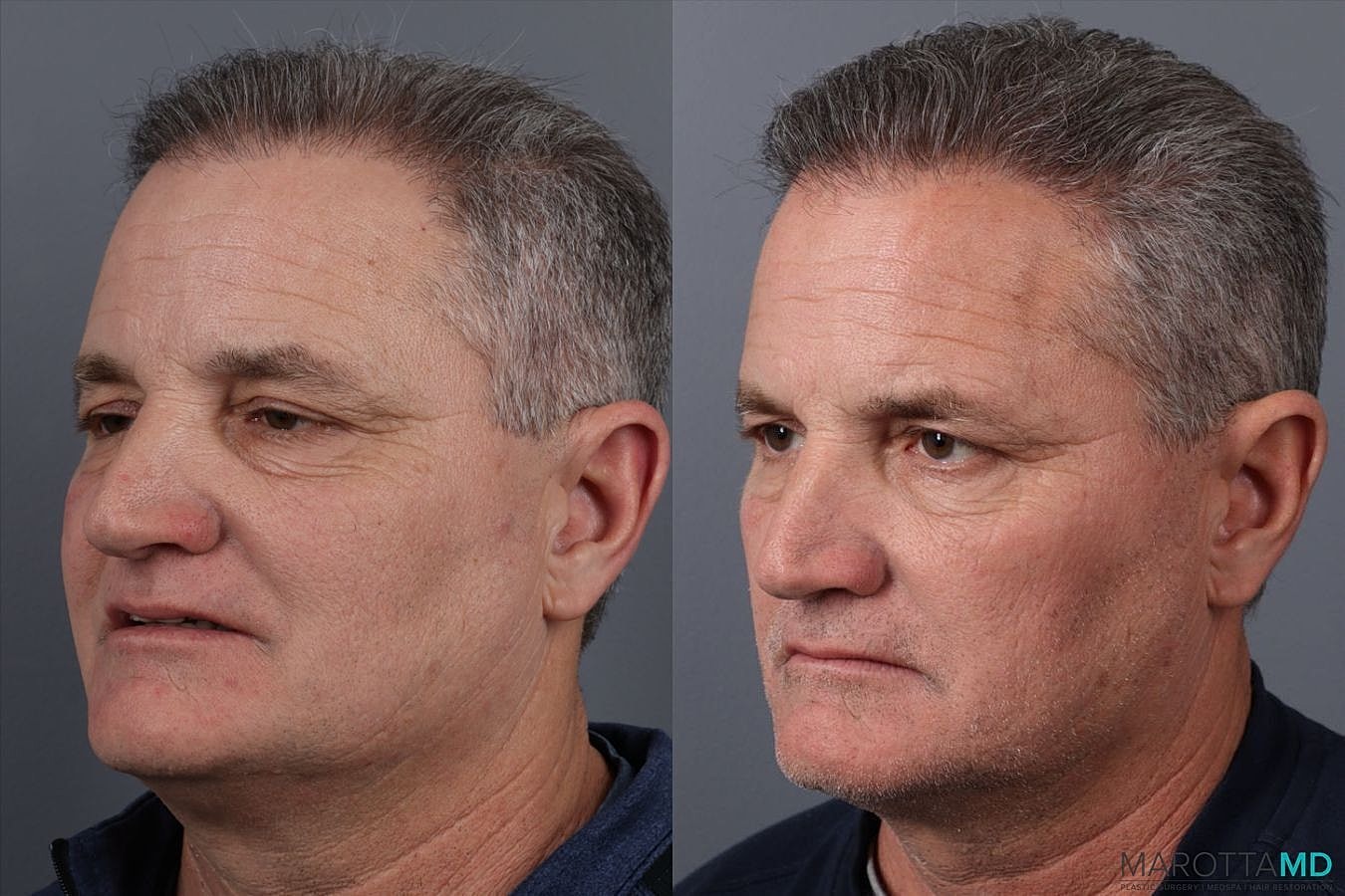 Hair Transplants Before & After