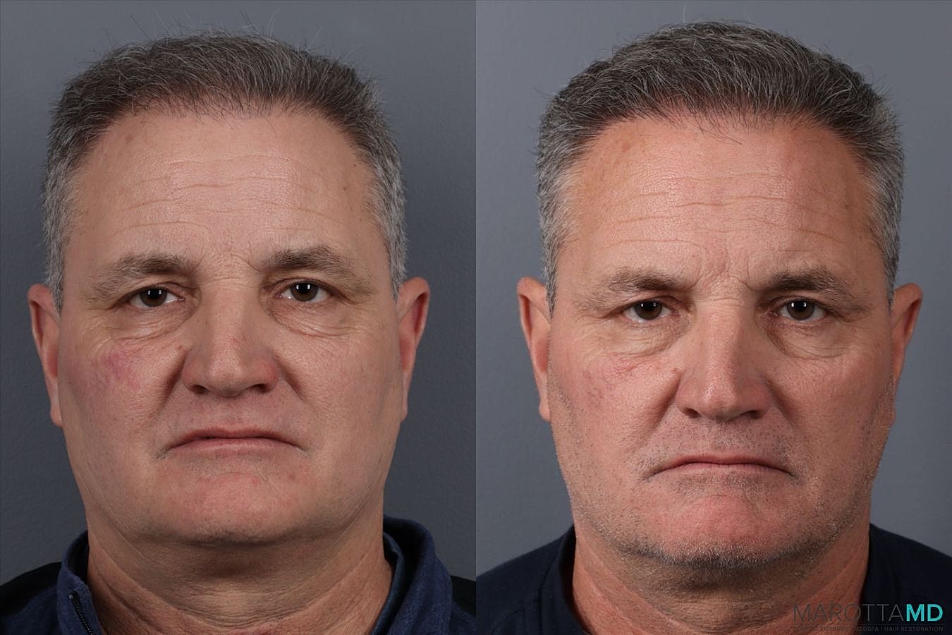 Hair Transplants Before & After