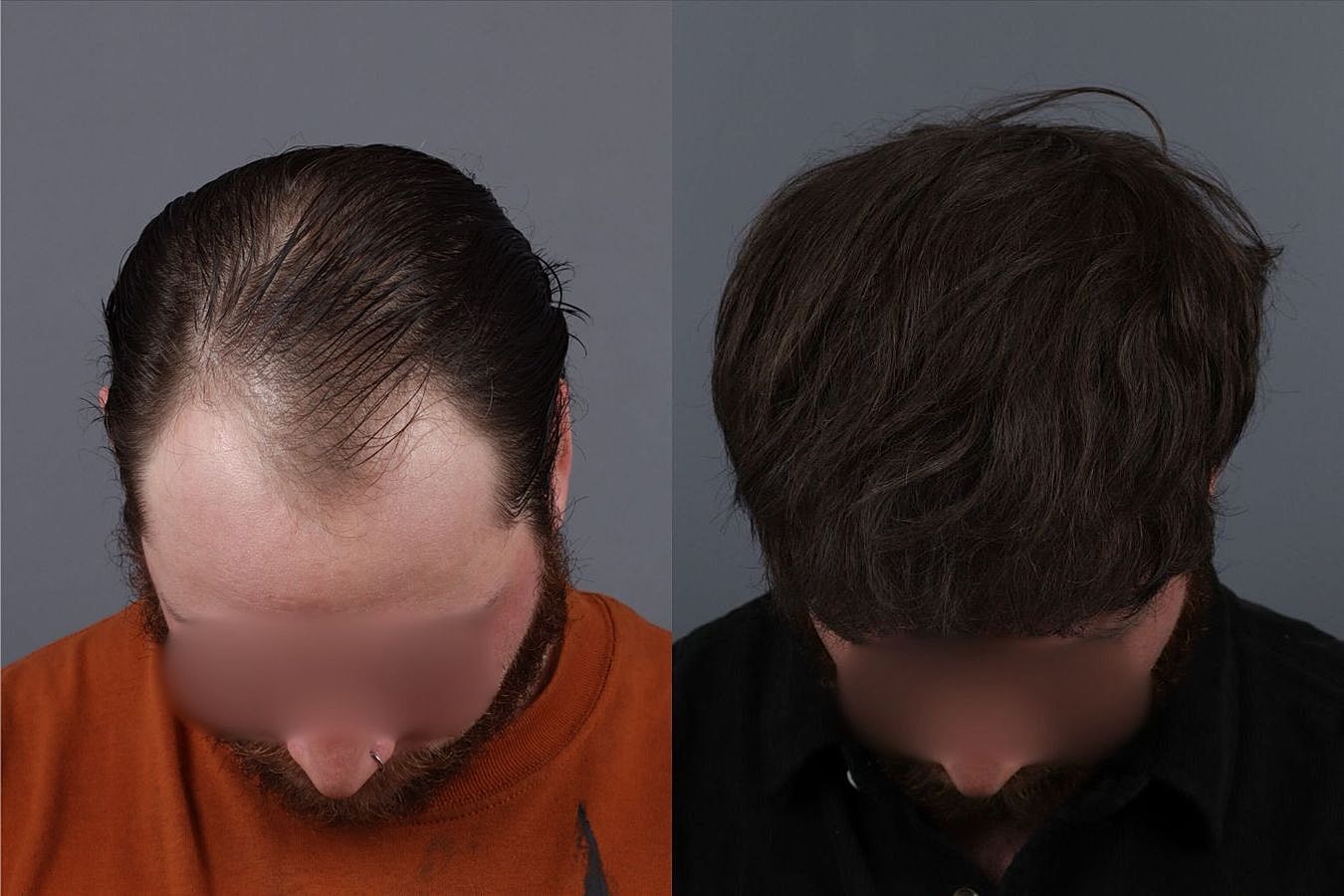 Hair Transplants Before & After