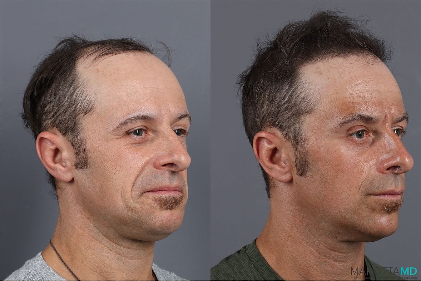 Hair Transplants Before & After
