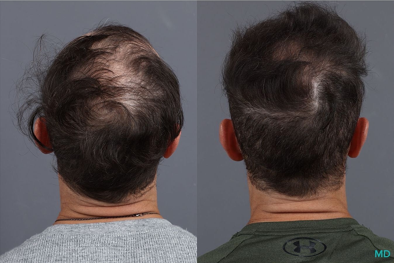 Hair Transplants Before & After