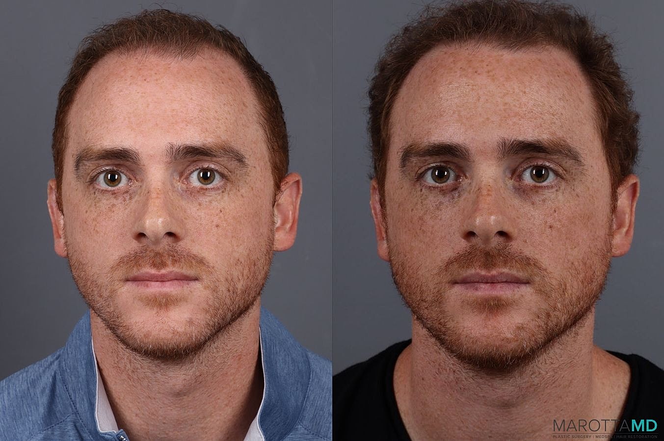 Prp Scalp Treatment Before & After