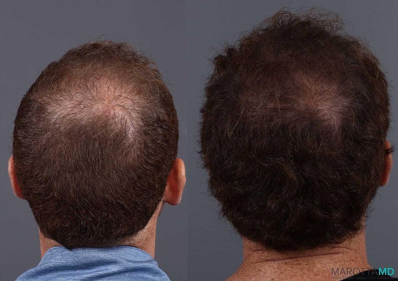 Prp Scalp Treatment Before & After