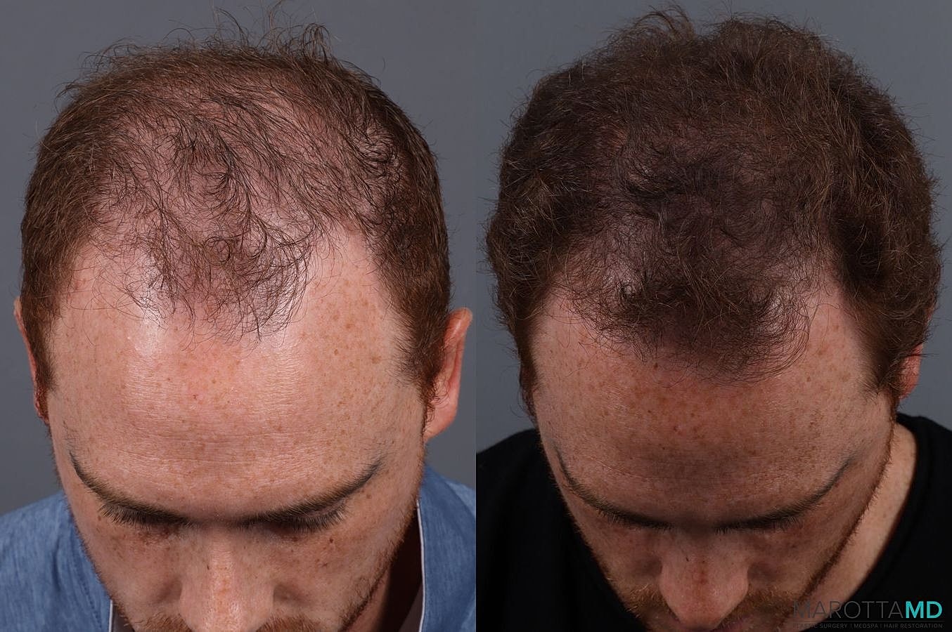Prp Scalp Treatment Before & After