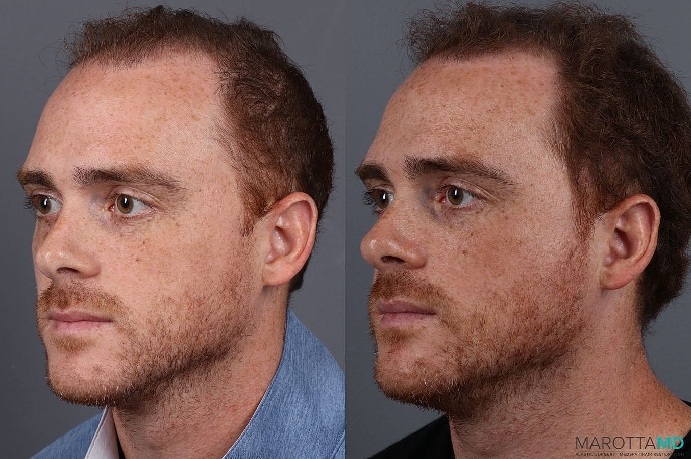 Prp Scalp Treatment Before & After