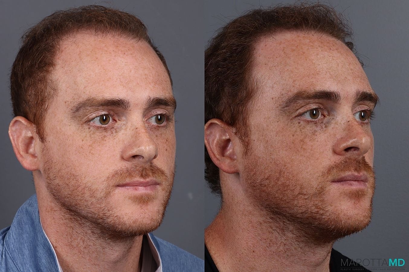 Prp Scalp Treatment Before & After