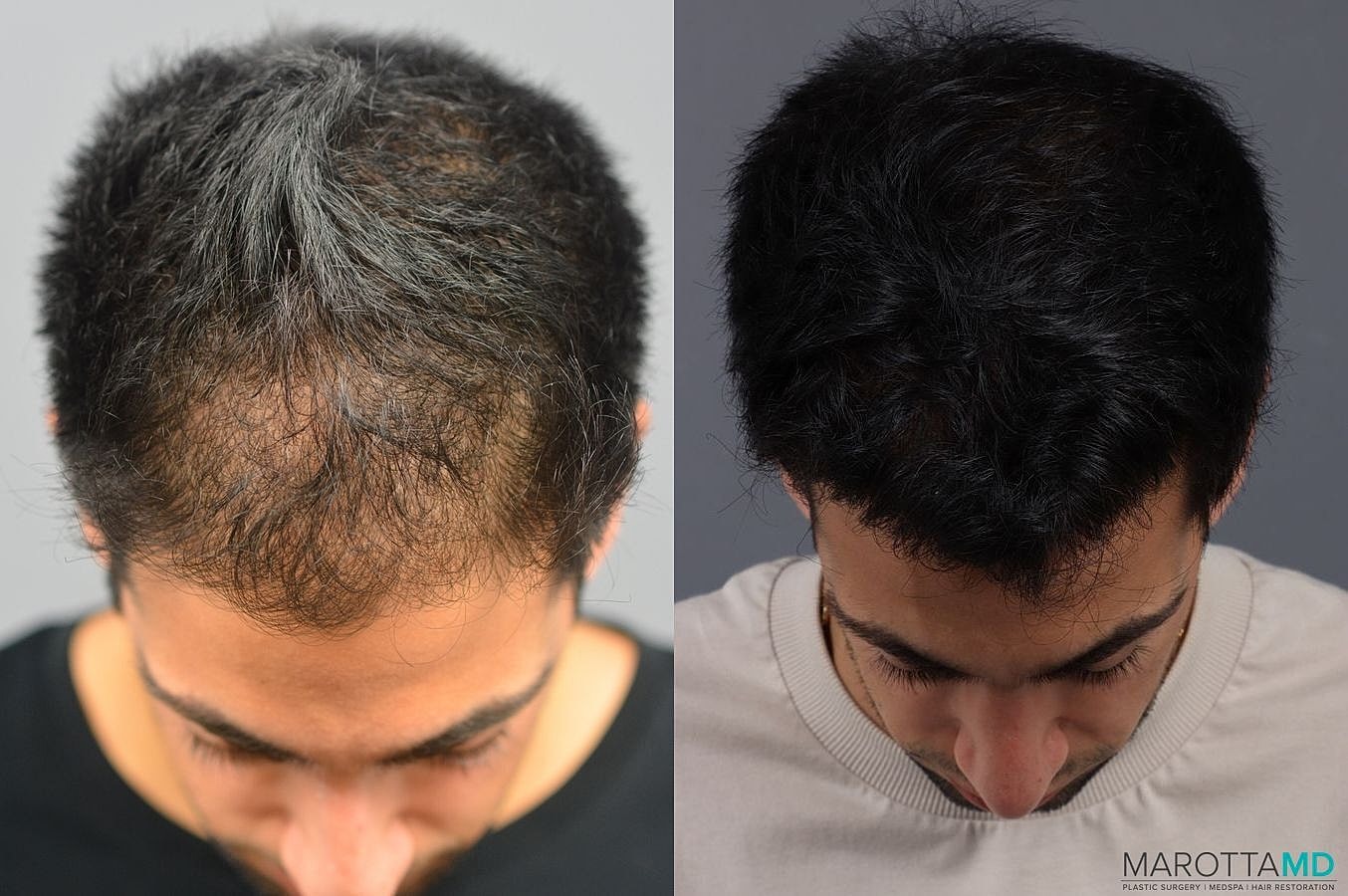 Prp Scalp Treatment Before & After