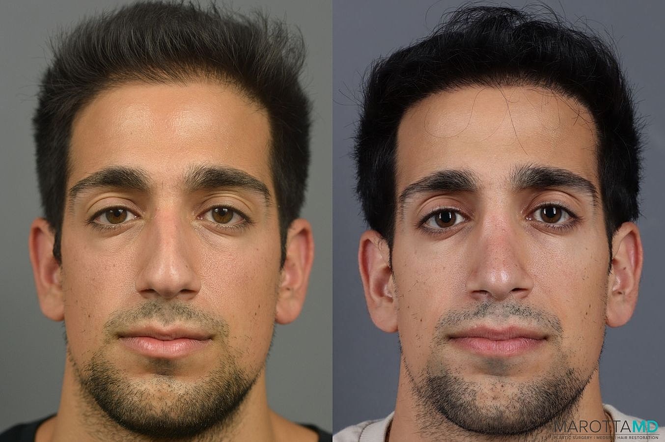 Prp Scalp Treatment Before & After