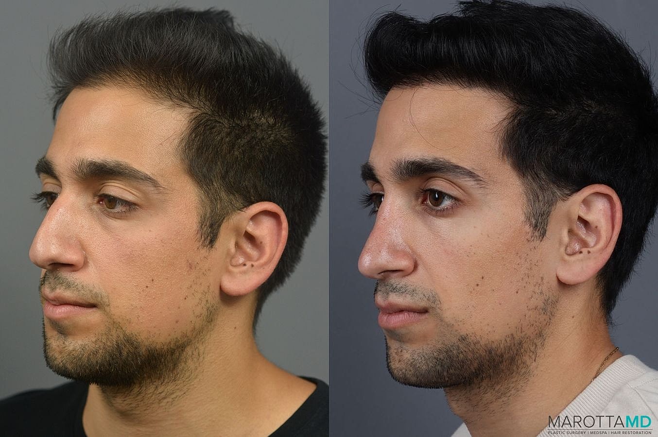Prp Scalp Treatment Before & After