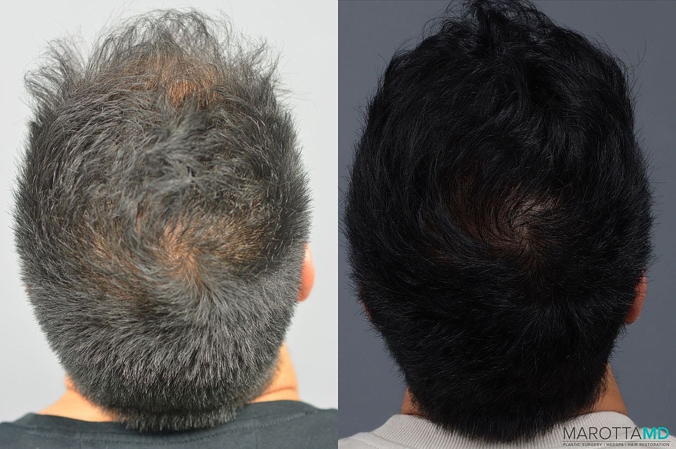 Prp Scalp Treatment Before & After
