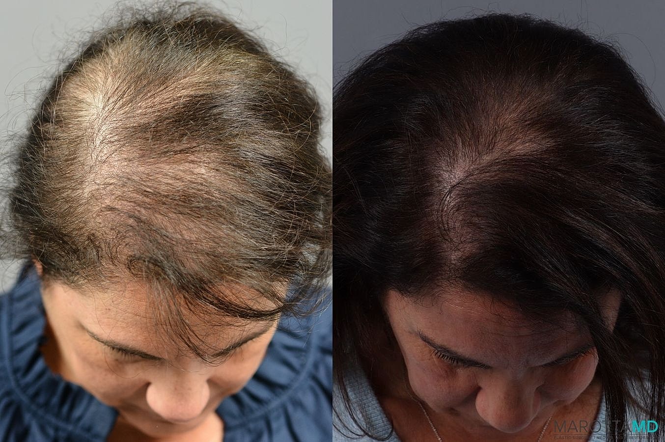 Prp Scalp Treatment Before & After