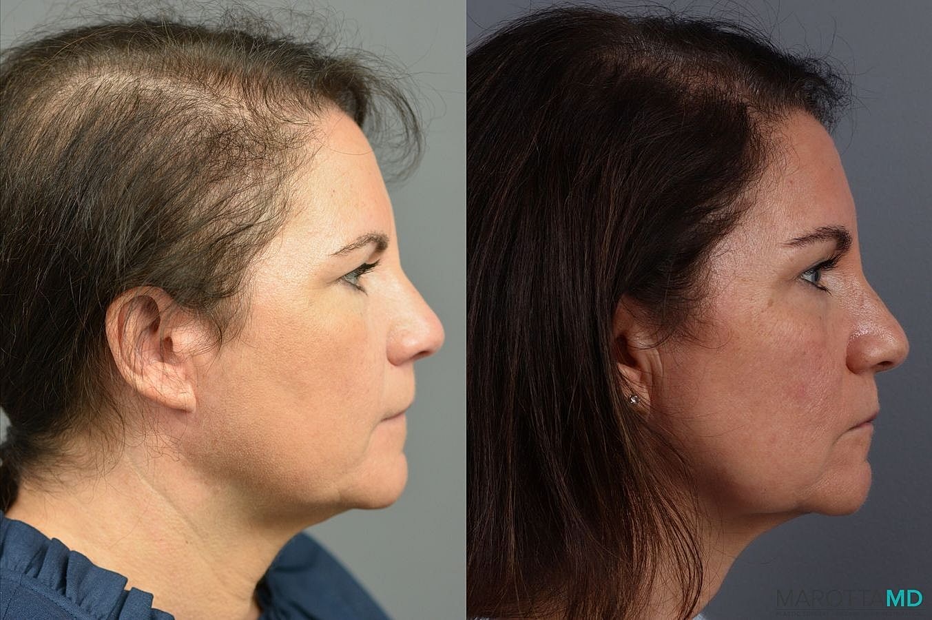 Prp Scalp Treatment Before & After