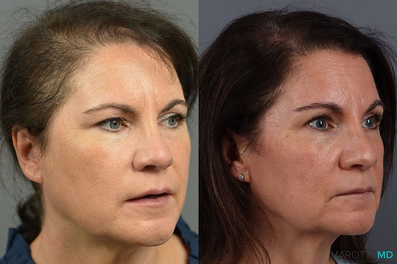 Prp Scalp Treatment Before & After