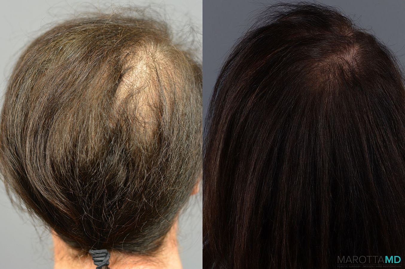 Prp Scalp Treatment Before & After