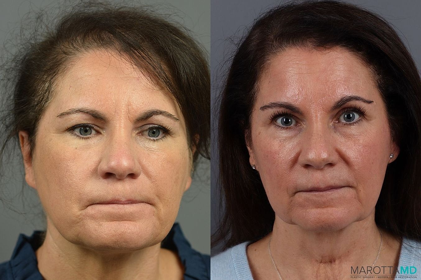 Prp Scalp Treatment Before & After