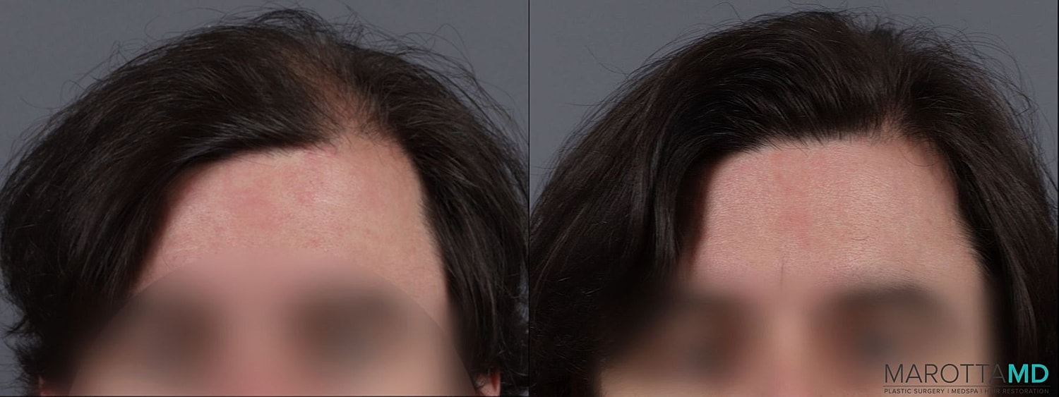 Prp Scalp Treatment Before & After