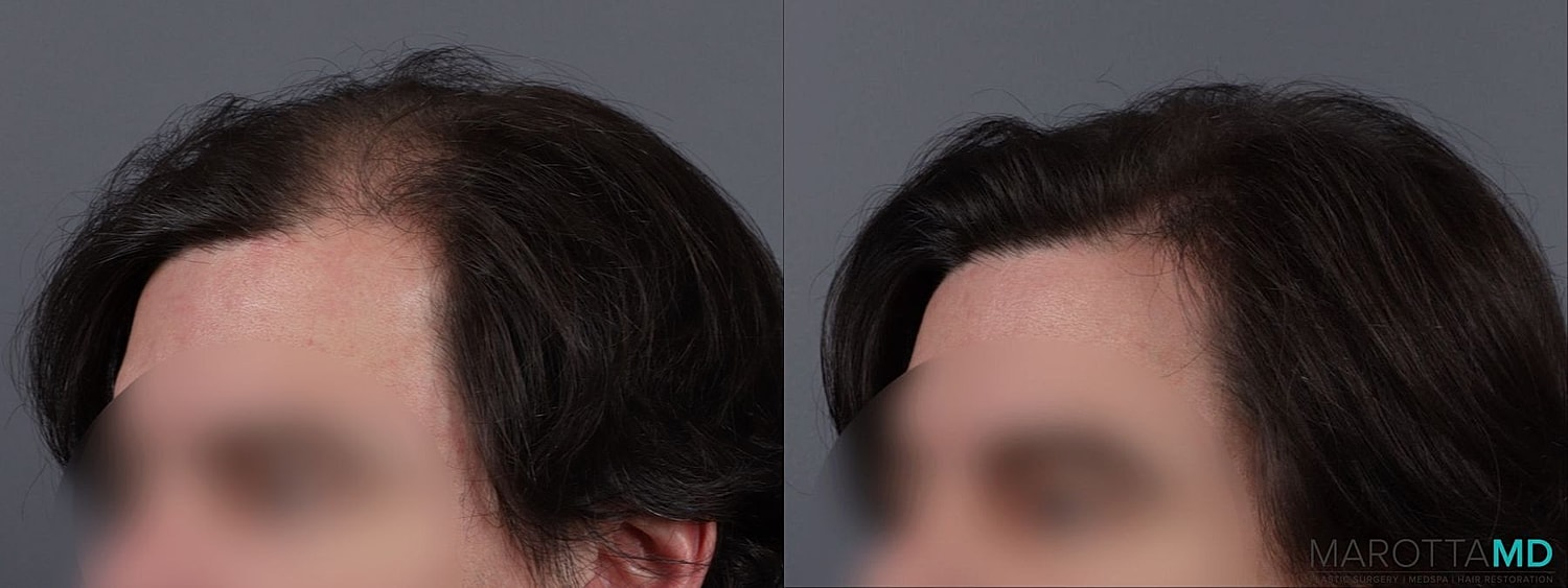 Prp Scalp Treatment Before & After