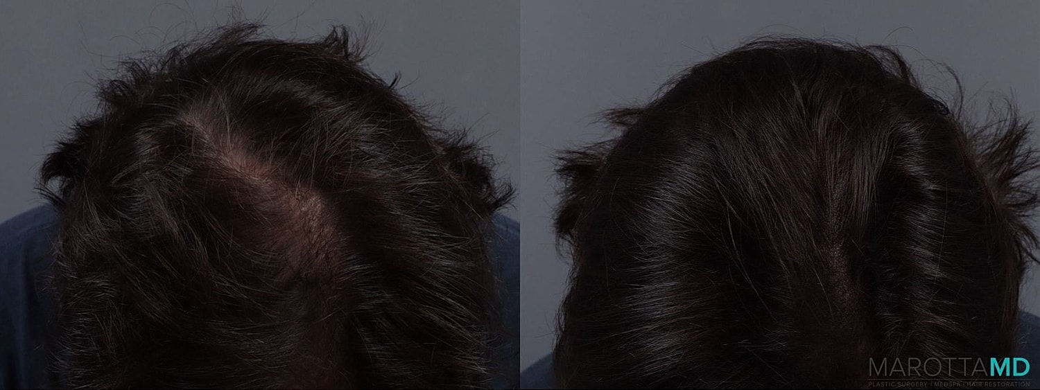 Prp Scalp Treatment Before & After