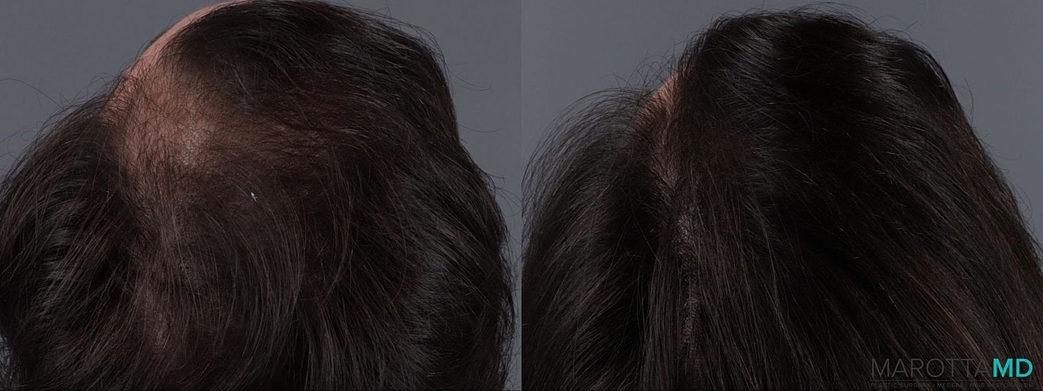 Prp Scalp Treatment Before & After