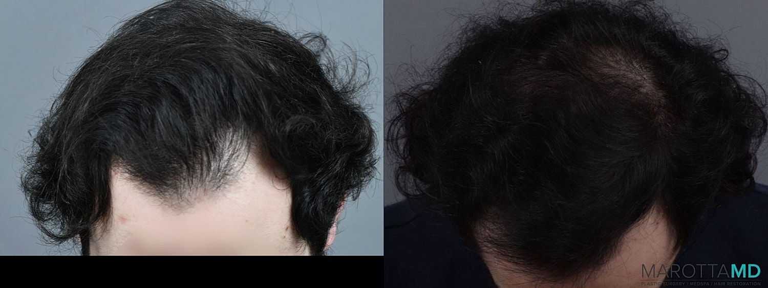 Prp Scalp Treatment Before & After