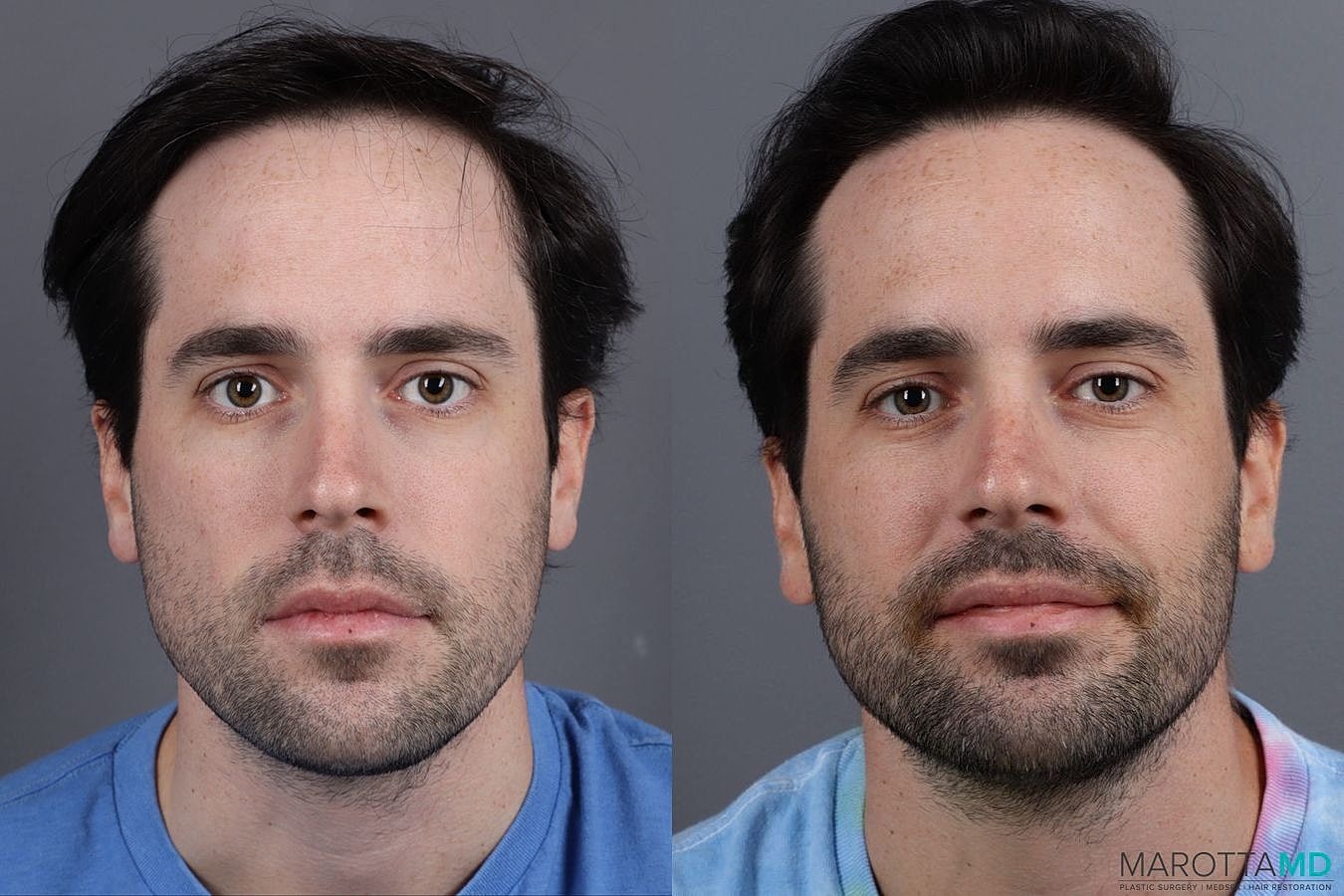 Prp Scalp Treatment Before & After