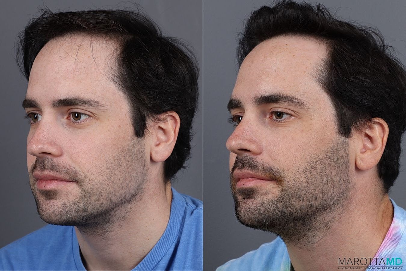 Prp Scalp Treatment Before & After