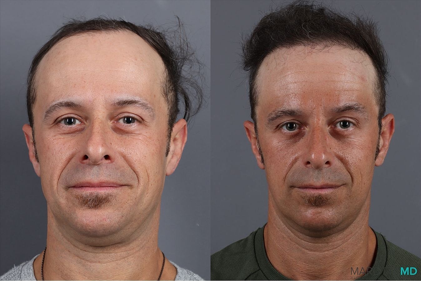 Prp Scalp Treatment Before & After