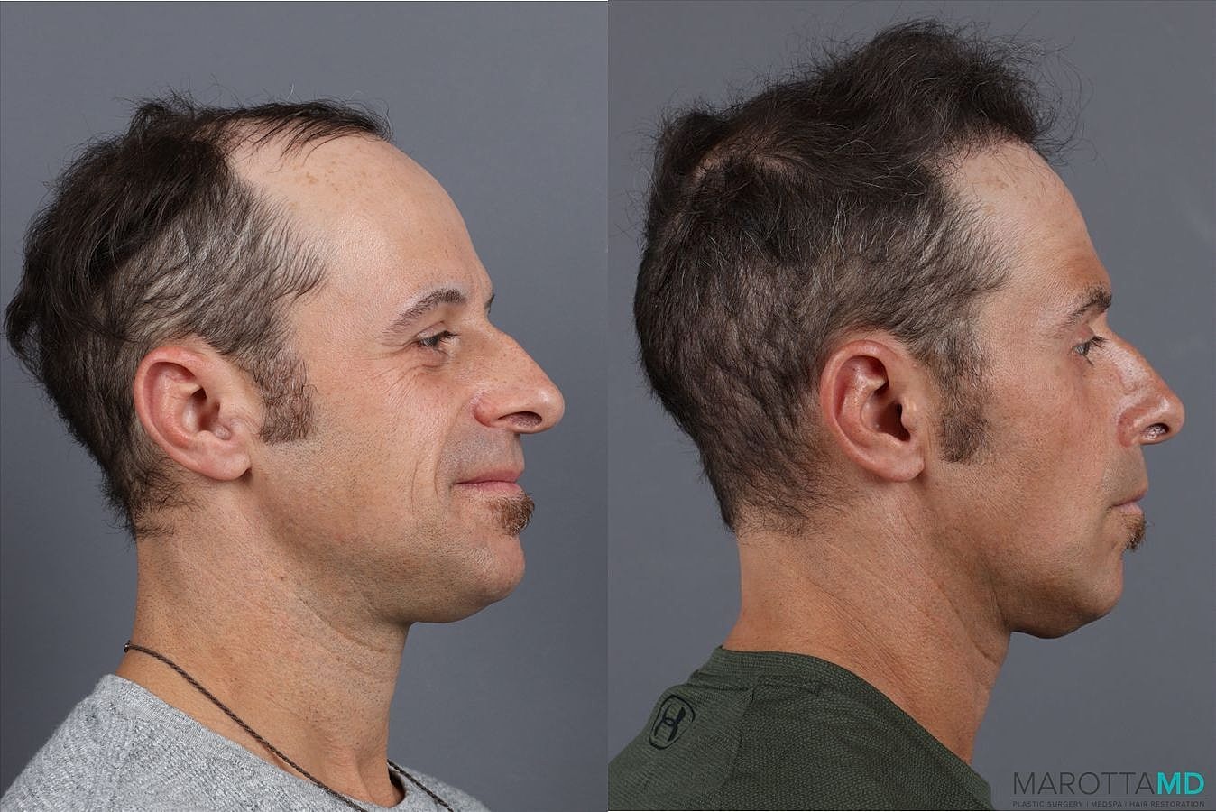 Prp Scalp Treatment Before & After